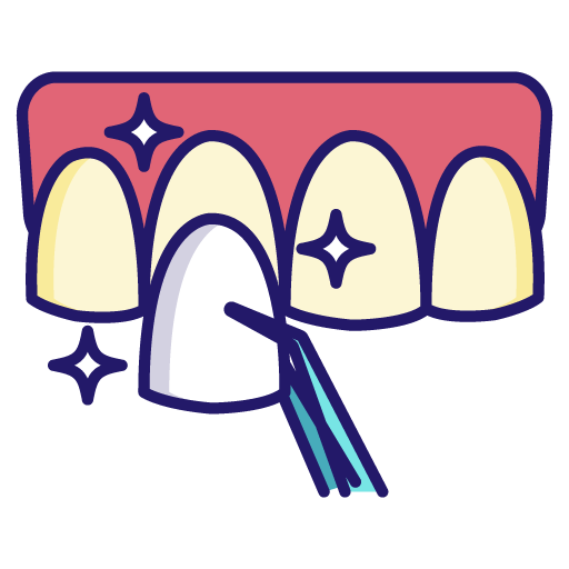 Dental_veneer512px